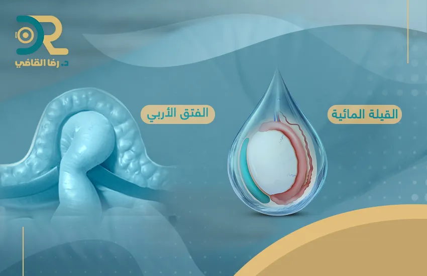الفرق بين القيلة المائية والفتق الإربي