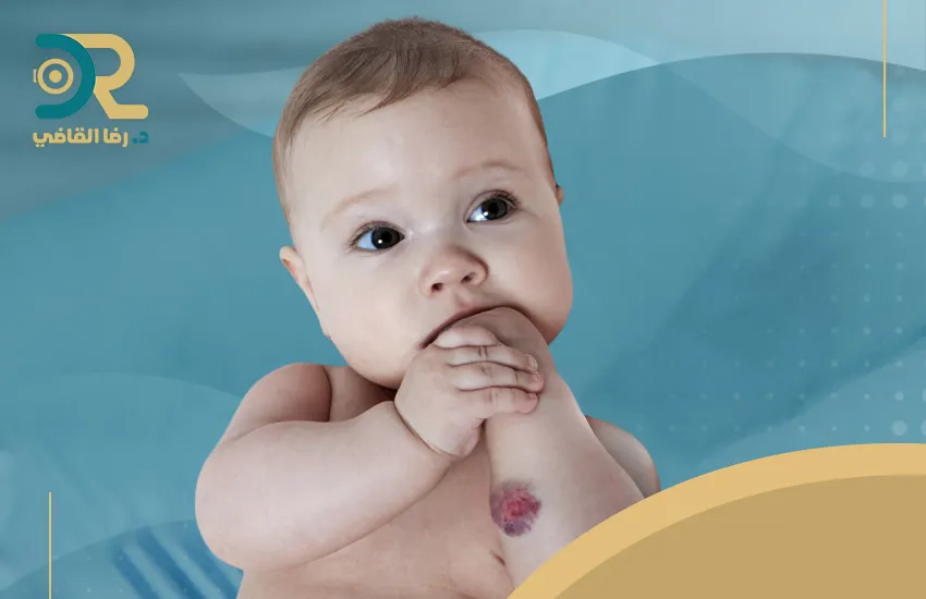 علاج الوحمة الدموية