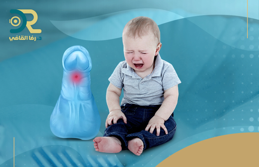 مضاعفات عملية الإحليل التحتي