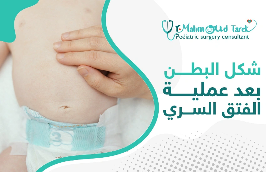 كيف يكون شكل البطن بعد عملية الفتق السري للأطفال؟