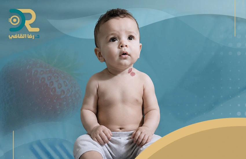 وحمة الفراولة عند الاطفال